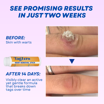Timilk® TagZero Wart Removal Stick🌟