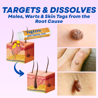 Timilk® TagZero Wart Removal Stick🌟