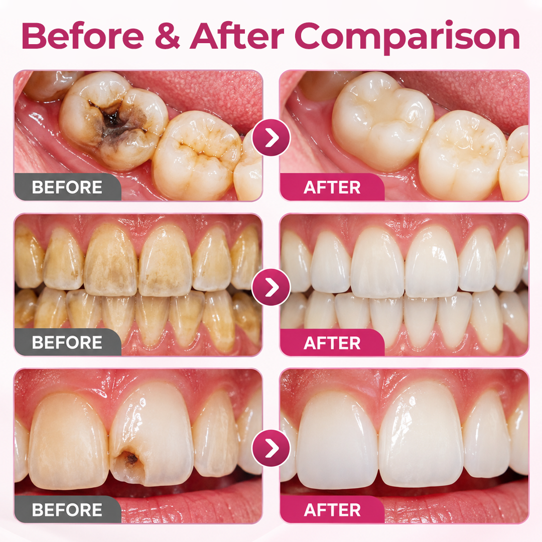 Timilk® DenPerm Cavity-Repair Natural Enamel Filling Gel 🌟