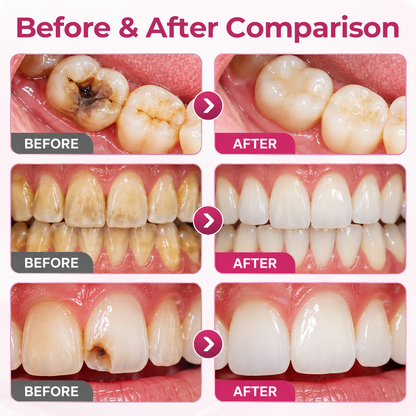 Timilk® DenPerm Cavity-Repair Natural Enamel Filling Gel 🌟