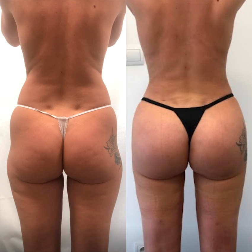 Ceoerty® Curvessa Micro-Needle Sculpting Patches